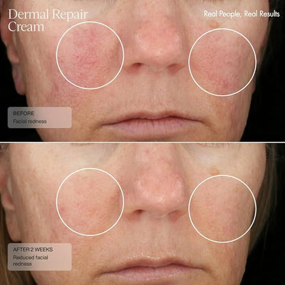Senté Dermal Repair Facial Cream | Nourishing for Rosacea & Sensitive Skin | Hydrate & Rejuvenate | with Patented HSA, Vitamin E & Green Tea Extract - 1.7 Fl Oz