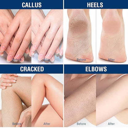 OUKEYA Urea Cream 40 Percent, Foot & Hand Cream for Dry Cracked, Urea Lotion for Feet Maximum Strength(12.35Oz X 2 Packs)