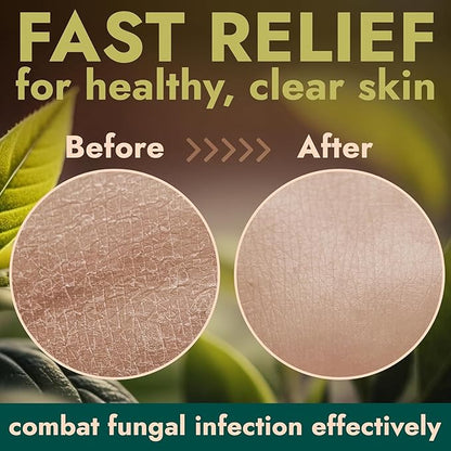 Antifungal Body Wash with Tea Tree Oil | Antibacterial Soap for Back Acne, Eczema & Jock Itch,Treats Ringworm | Antibacterial Body Soap For Men And Women (1% Tolnaftate Medicated Body Wash) 16.9 oz