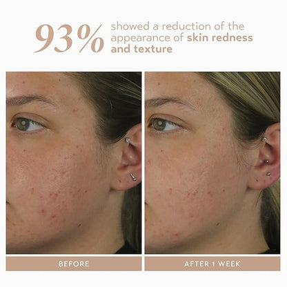 Shani Darden Rescue Serum with 10% Azelaic Complex, Lightweight Hydrating Azelaic Acid Serum for Face with Oat Kernel & Aloe Extracts, Helps Skin Redness & Acne, Non-Comedogenic, Vegan, 1 fl oz