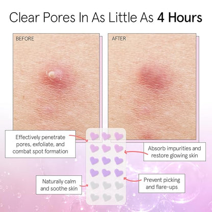 grace & stella Award Winning Pore Strip - Pimple Patches for Face - Heart Hydrocolloid Zit Stickers that Help Soothe & Conceal Breakouts - Cute Patches - Dermatologist-Tested, Vegan (Heart, 72 Count)