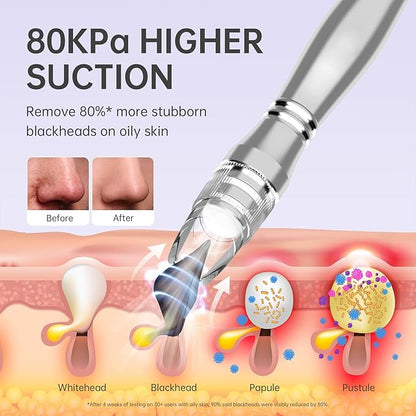 UNOISETION Blackhead Vacuum Removers, 2 in 1 Pro-Grade at-Home Spa Facial Vacuum Pore Cleaner for Blackheads, Whiteheads, Exfoliation, 20-80 Kpa Adjustable Suction for All Skin Types, White