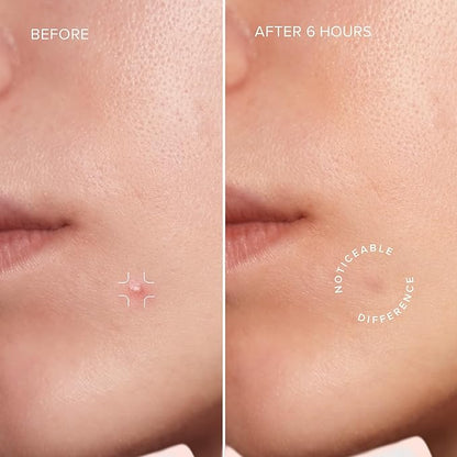 MAREE Star Pimple Patches for Face - Hydrocolloid Acne Patches w/Salicylic Acid, Tea Tree Oil & Centella - Cute Pimple Patches Stars - Teens Zit Patches Stickers - Parches Para Acne - 72 Blemish Dots