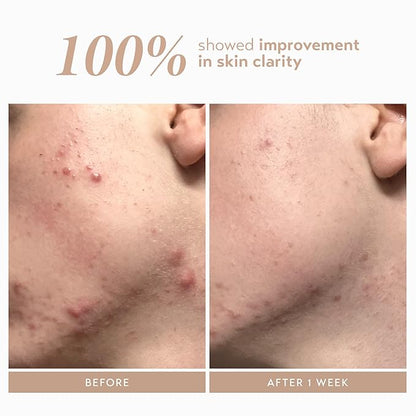 Shani Darden Rescue Serum with 10% Azelaic Complex, Lightweight Hydrating Azelaic Acid Serum for Face with Oat Kernel & Aloe Extracts, Helps Skin Redness & Acne, Non-Comedogenic, Vegan, 1 fl oz