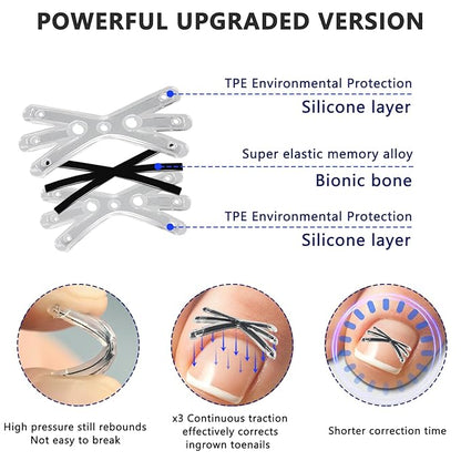 Upgraded MI-shaped Design Titanium Alloy Ingrown Toenail Corrector for Quick Pain Relief, Ingrown Toenail Treatment and Removal Tool Kit for Effective Curved Nail Repair, 6pcs