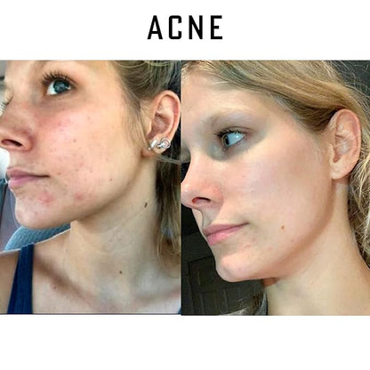 Pure Organic Ozonated Olive Oil Extra Strength 1200 Peroxide For Face and Skin Helps In Acne, Anti-Aging, Wrinkles and Rosacea For Sensitive Skin Made in Spain