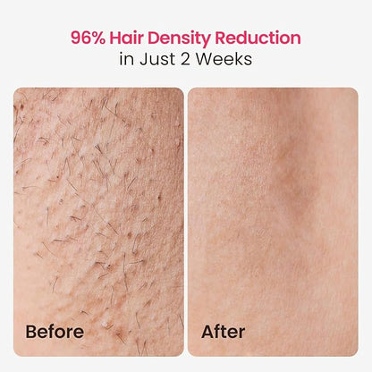 IPL Laser Hair Removal for Women and Men, 25J Triple-Pulse Permanent Hair Removal Device for Ingrown & Coarse Hair, 37°F Painless Sapphire Ice Cooling Hair Removal for Legs, Facial, Armpits, Bikini