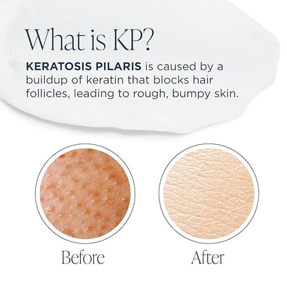 Glytone KP Kit – Exfoliating Body Wash, Glycolic Acid Lotion & Shower Pouf for Keratosis Pilaris – Smooth Rough Bumpy Skin, Fragrance-Free Skincare Routine for Dry Skin & Chicken Skin – Routine Kit