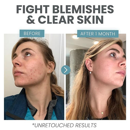 Vitamin C Serum for Face with Retinol & Salicylic Acid – Skin Clearing Acne Spot Treatment with Niacinamide, Hyaluronic Acid, MSM – Anti-Aging Facial Serum for Dark Spots and Blemishes
