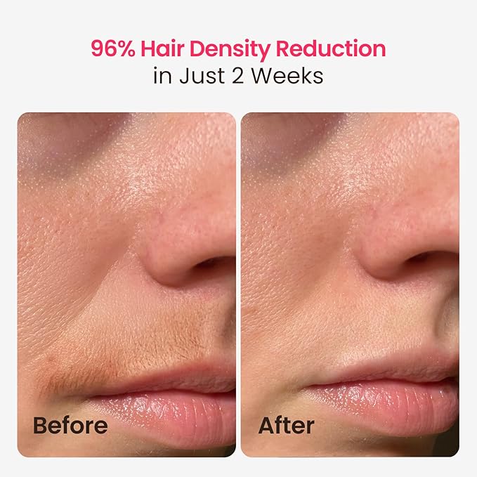 IPL Laser Hair Removal for Women and Men, 25J Triple-Pulse Permanent Hair Removal Device for Ingrown Hair, 37°F Painless Sapphire Ice Cooling Hair Removal for Legs, Armpits, Face, Bikini, Underarms