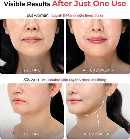 Aalok Ultra Olla | at-Home RF & LED Facial Device for Lifting, Anti-Aging Routine