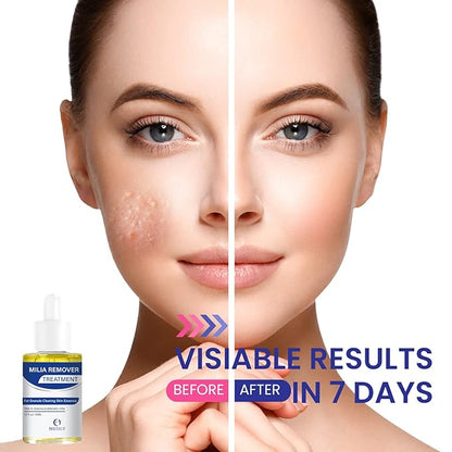 Milia Remover treatment serum, Milia Spot Treatment with Salicylic Acid Milia Acne Serum 25 ML