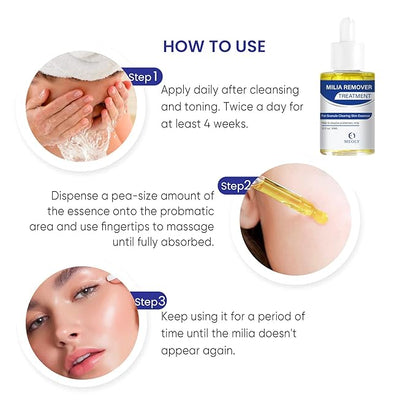 Milia Remover treatment serum, Milia Spot Treatment with Salicylic Acid Milia Acne Serum 25 ML