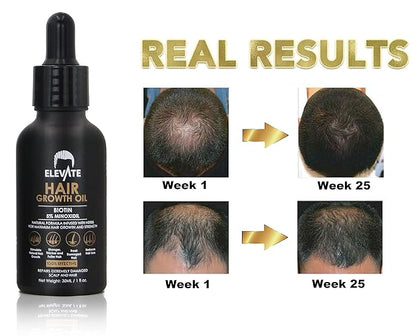 Elevate Hair Regrowth Treatment 5% Minoxidil Solution - Biotin Serum Hair Growth Oil for Men & Women - Thicker Fuller Stronger Hair - Stops Hair Loss & Thinning - Natural Hair Thickening Treatment 1oz