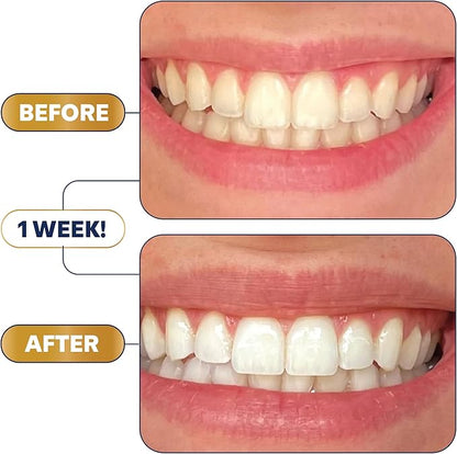 Lumineux Longevity Whitening Kit Bundle - Contains 6X Toothpastes, 6X Mouthwashes, 2X Strips and 2X Whitening Pens - Enamel Safe and Clinically Proven to Whiten Without The Sensitivity