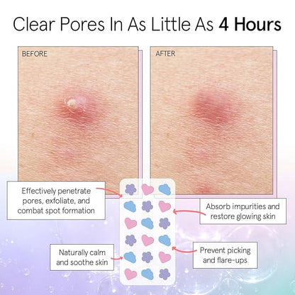grace & stella Award Winning Pimple Patches for Face - Dermatologist Tested Acne Patches - Hydrocolloid Patch for Breakouts, Whiteheads - Vegan Acne Spot Treatment for Face (Multishape, 216 Count)