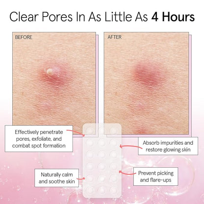 grace & stella Award Winning Multi-Size Pimple Patches for Face - Dermatologist Tested Acne Patches for Face - Hydrocolloid Patch for Breakouts, Whiteheads - Vegan Pimple Patch (Clear, 72 Pack)