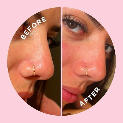 ZitSticka Pimple Patches for Face and Body, Goo Getter Hydrocolloid Patches to Cover Zits & Blemishes, Acne Patches or Zit Spot Stickers, Body Blemish Patch (Nose Strip Pack 8 Pack)