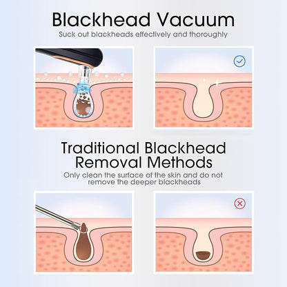 Yccu Blackhead Remover Vacuum Pore Extractor Black Head Remover for Face and Nose Blackhead Extractor Tool Pore Cleane Vacuum with USB Charge 4 Modes 5 Suction Heads for Women and Men (Black)