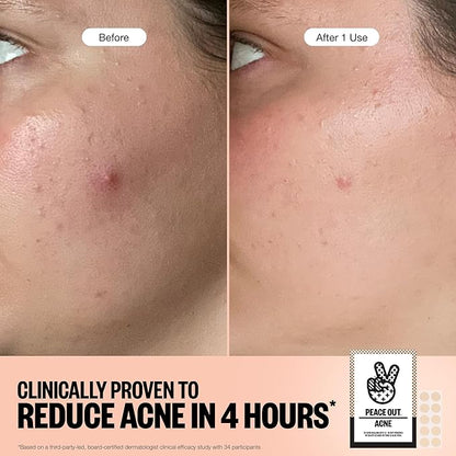 PEACE OUT Acne Healing Dots Helps Clear Blemishes Overnight, Fast Acting Hydrocolloid Pimple Patches for Breakouts with Salicylic Acid, Retinol and Aloe Vera, Award Winning Skincare Solution 20 Count
