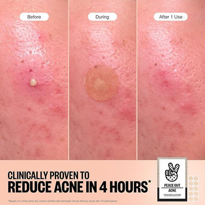 PEACE OUT Acne Healing Dots Helps Clear Blemishes Overnight, Fast Acting Hydrocolloid Pimple Patches for Breakouts with Salicylic Acid, Retinol and Aloe Vera, Award Winning Skincare Solution 20 Count
