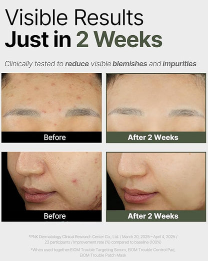 Trouble Patch Mask – Hydrating & Clarifying Korean Sheet Mask with Tea Tree Biome, Pore Vacuum Effect for Sebum & Oil Control, Calming Microbiome Skincare, Stocking Stuffer for Teens | 20ml x 4ea