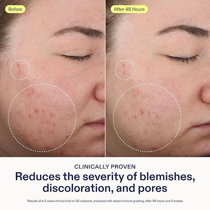 Skinfix 2% BHA Cleanser - 1 oz - Clears Acne Blemishes & Blackheads - Safe for All Types of Acne - Fragrance Free - Vegan, Cruelty Free