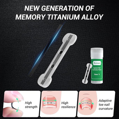 Titanium Alloy Ingrown Toenail Treatment, Nail Tools, and Ingrown Toenail Removal Kit Specially Designed for Curved Nail Repair and Ingrown Toenail Corrector (0.59/0.67in)