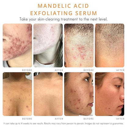 Almond Clear Level 1 Serum | Mandelic Acid Facial Serum for Acne, Folliculitis, Aging Skin, Ingrown Hairs, Dark Spots on Face, Chest, Butt, Back, Thighs, Arms | 4oz