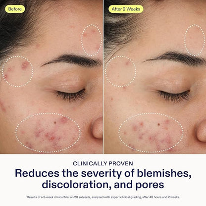 Skinfix 2% BHA Cleanser - 1 oz - Clears Acne Blemishes & Blackheads - Safe for All Types of Acne - Fragrance Free - Vegan, Cruelty Free